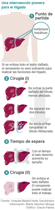 Una cirugía heroica para rescatar el hígado