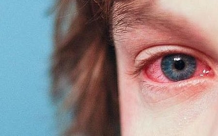 Remedios caseros para eliminar los ojos rojos2.jpg