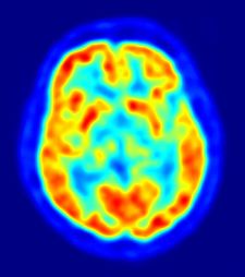 Bajos niveles de vitamina B12 pueden conducir a reducci贸n del volumen cerebral y a padecer problemas cognitivos Bajos niveles de vitamina B12 pueden conducir a reducci贸n del volumen cerebral y a padecer problemas cognitivos