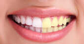 Dientes amarillos como blanquearlos sin riesgos