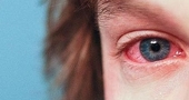 Remedios caseros para eliminar los ojos rojos