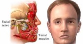 Paralisis facial