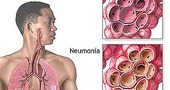 Neumonia| informacion, video