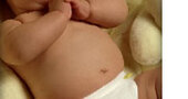 ¿Tu recién nacido tiene un ombligo cutáneo?