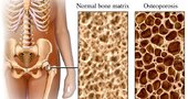 Qué es la Osteoporosis y cuales son sus síntomas