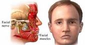 Parálisis facial: causas y su tratamiento