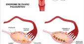 ¿Qué es el síndrome de ovarios poliquísticos?