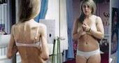 Síntomas de la anorexia