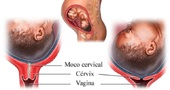 Síntomas de parto: Dilatación